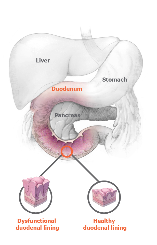 Healthy duodenal lining VS. Diseaseed duodenal lining